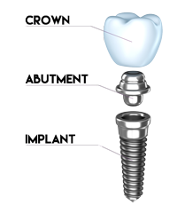 Dental Implant - Solutions for Missing Teeth