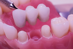 benefits of dental bridges