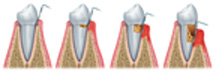 Stages of Gum Disease