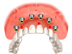 Dental Implant - Solutions for Missing Teeth