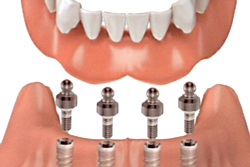 Dental Implant - Solutions for Missing Teeth