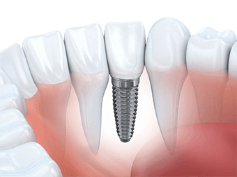 Dental Implant Services
